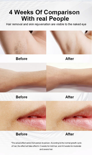 Numiere IPL Hair Removal with Ice Cooling - luminanrg