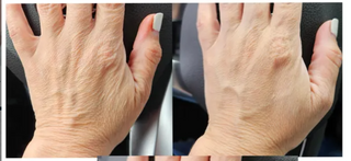 Numiere Hand Glow – LED Light Therapy for Hand & Wrist Rejuvenation
