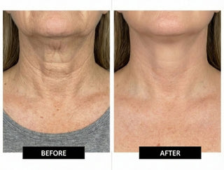 Numiere EMS Neck & Face Lift